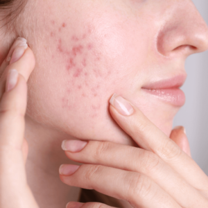 Skin inflammation on the face caused by chronic conditions.